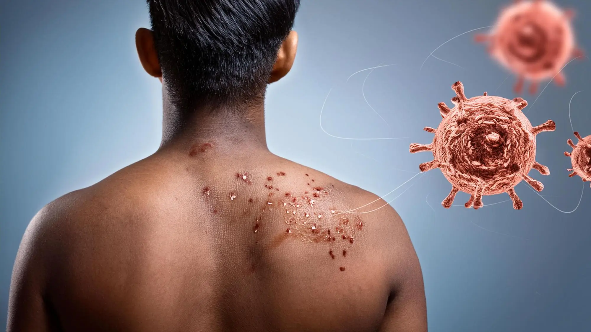 tratament infectii cutanate