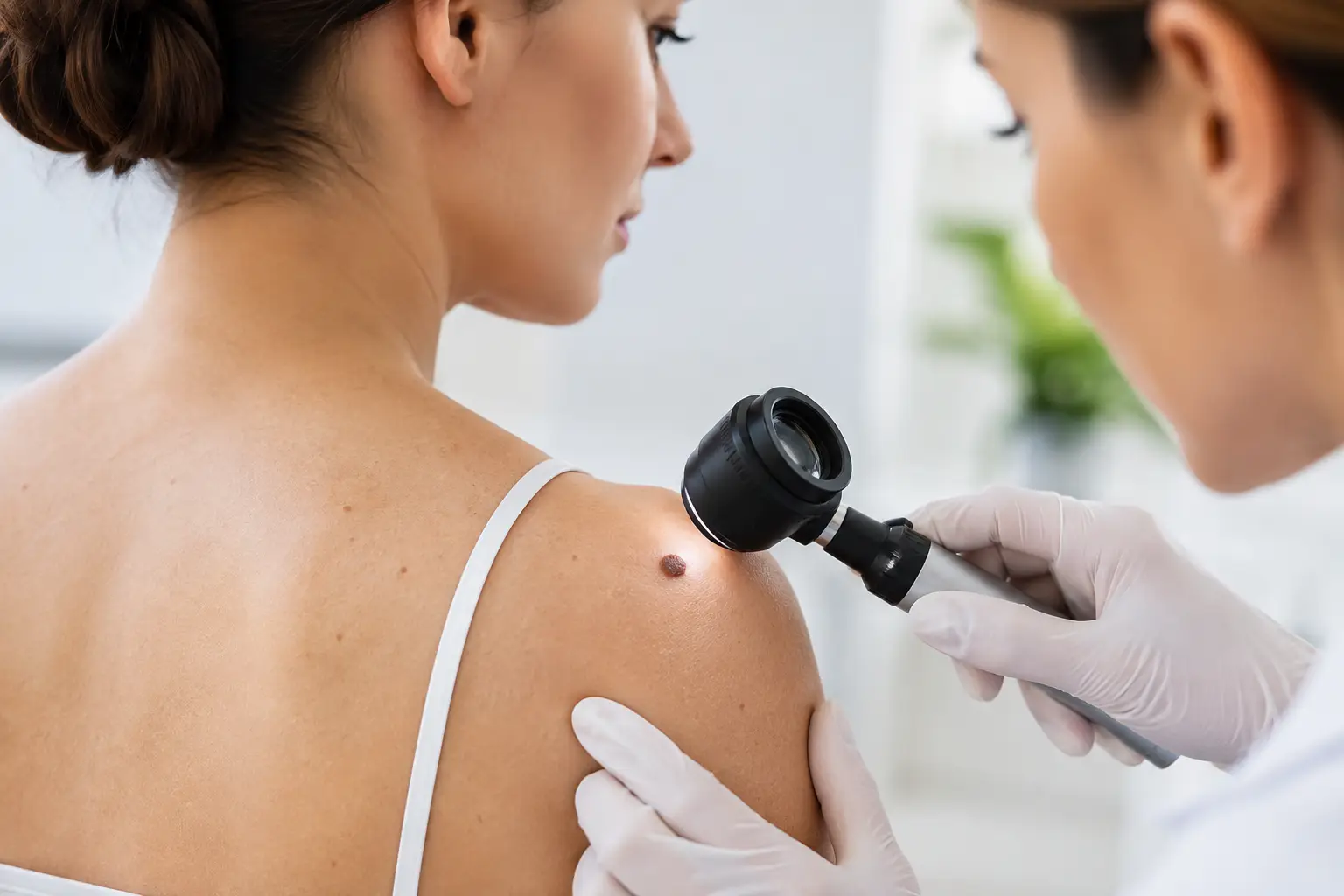 Cancer de piele: când o aluniță trebuie verificată